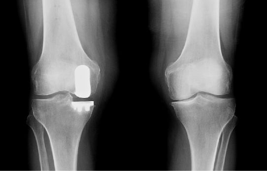 Mako Partial Knee Replacement